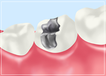 メタルインレー（銀歯）