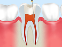 根管治療の流れ