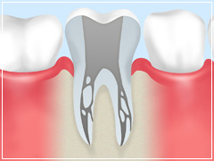 根管治療の必要性