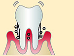 重度歯周炎